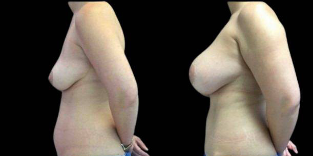 This is a 32-year-old female that has had a mommy makeover showing the before and after's side-by-side