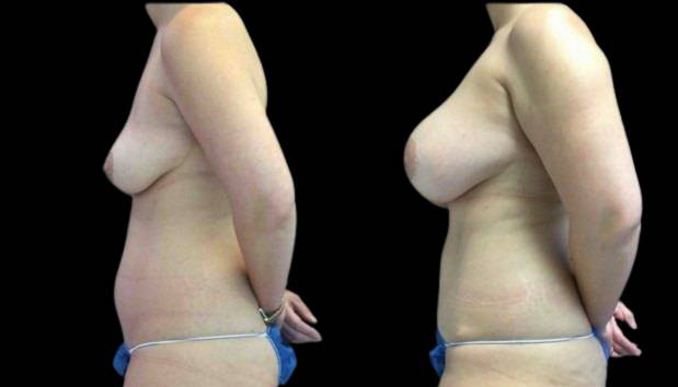 32-year-old-female-mommy-makeover-body-before-and-after-side-view.jpg