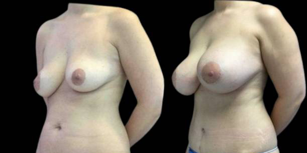 This is a 32-year-old female that has had a mommy makeover showing the before and after's side-by-side