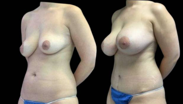 32-year-old-female-mommy-makeover-body-before-and-after-three-quarters-view.jpg