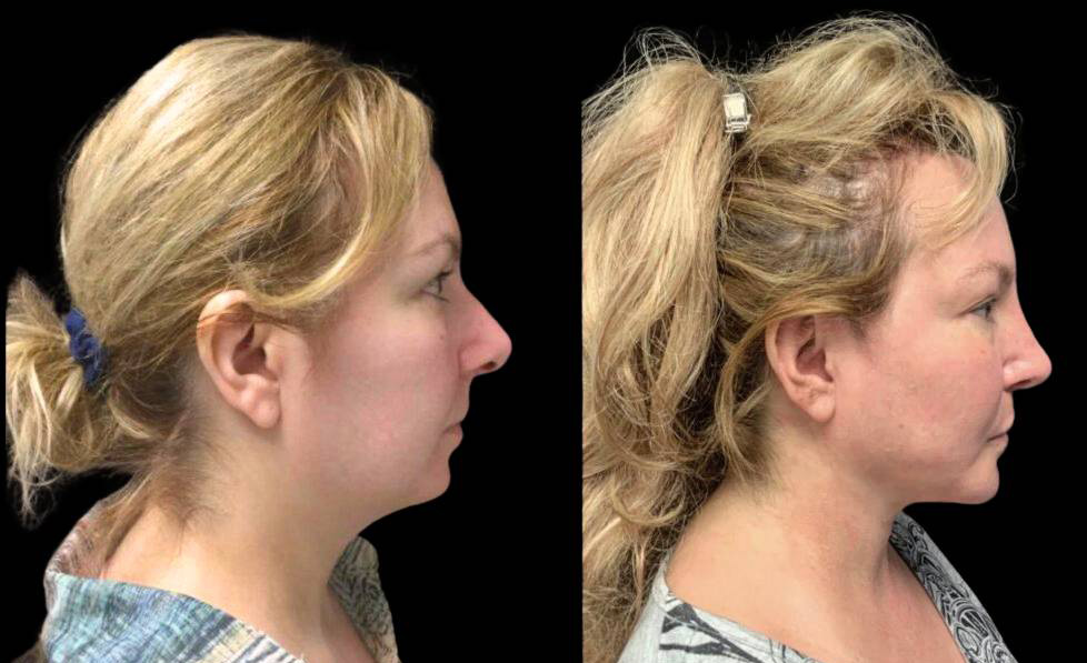 32-year-old-female-necklift-before-and-after-front-view.jpg