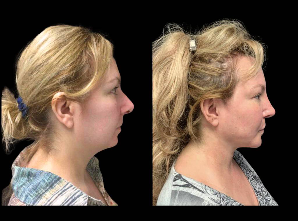 32-year-old-female-necklift-before-and-after-front-view.jpg
