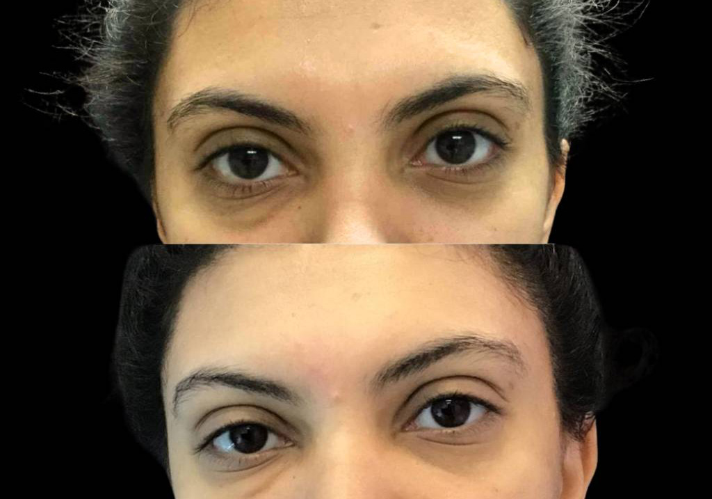 32-year-old-female-restylane-before-and-after-front-view-27917.jpg