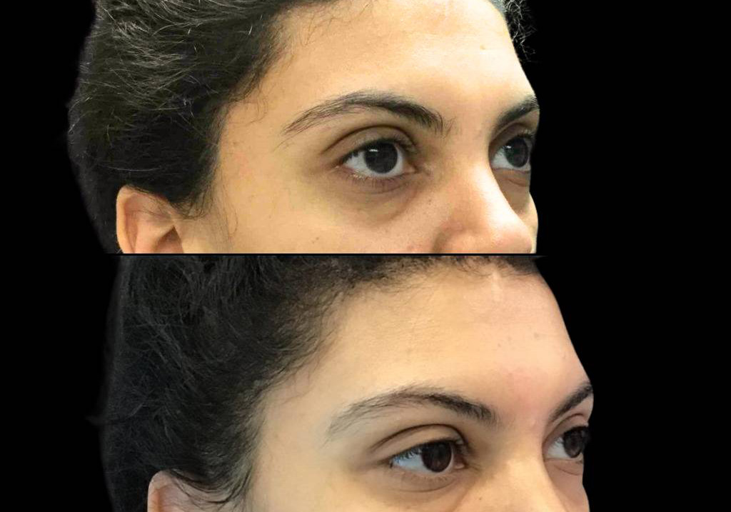 32-year-old-female-restylane-before-and-after-three-quarter-view.jpg