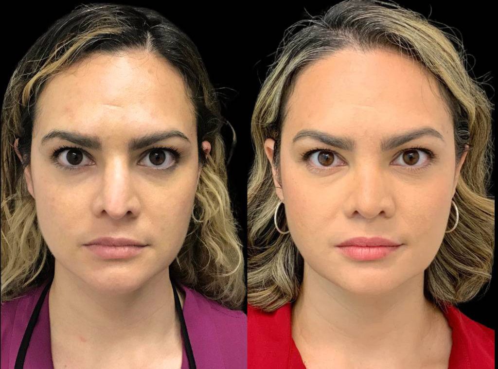 32-year-old-female-rhinoplasty-before-and-after-front-view-1.jpg