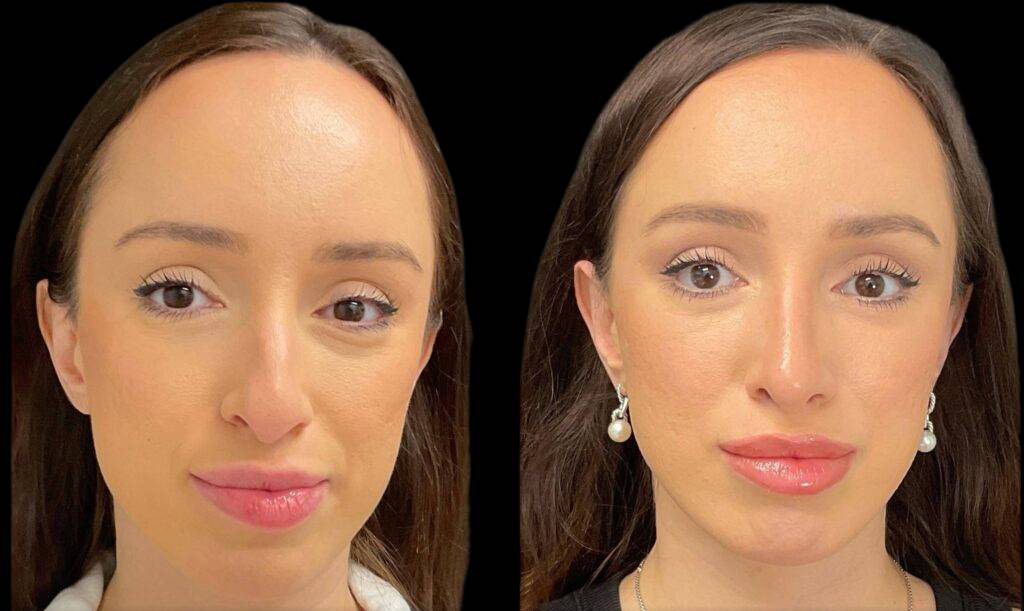32-year-old-female-rhinoplasty-before-and-after-front-view-2.jpg