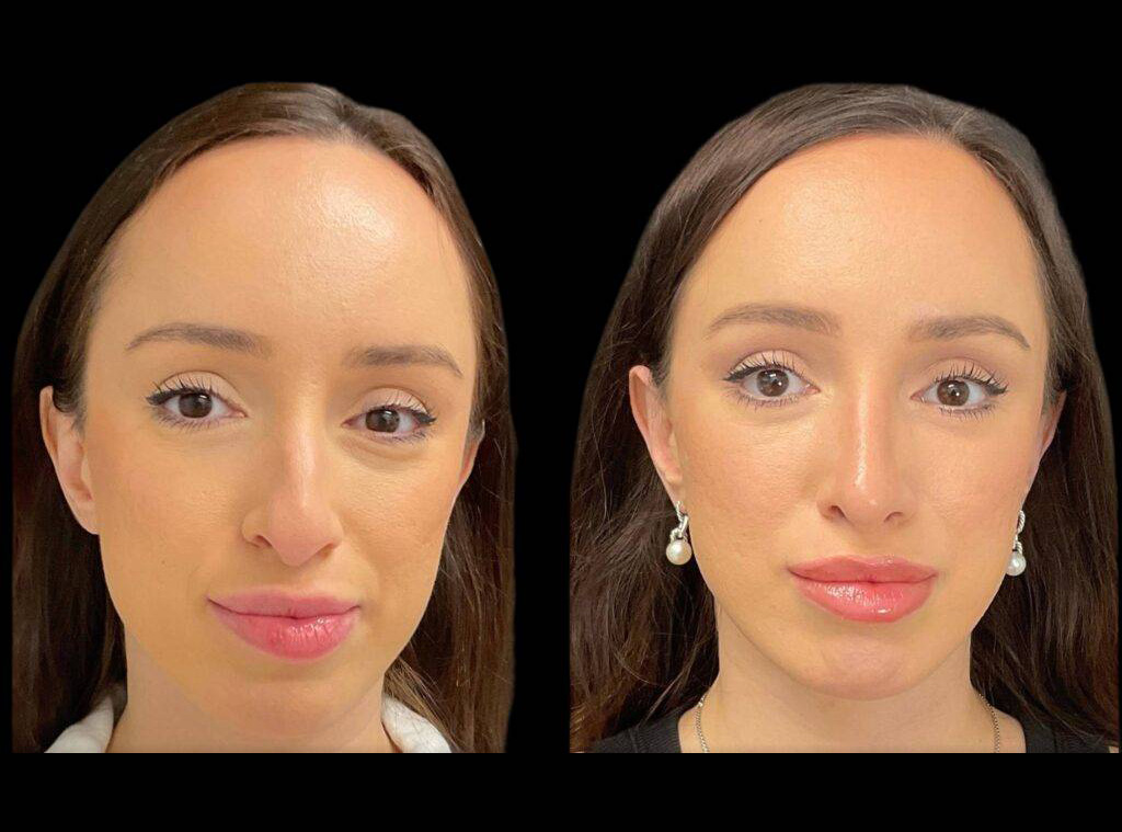 32-year-old-female-rhinoplasty-before-and-after-front-view-2.jpg