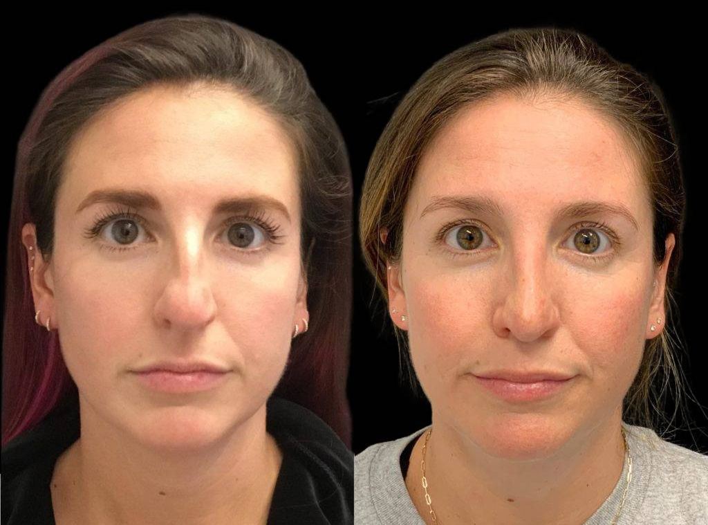32-year-old-female-rhinoplasty-before-and-after-front-view.jpg