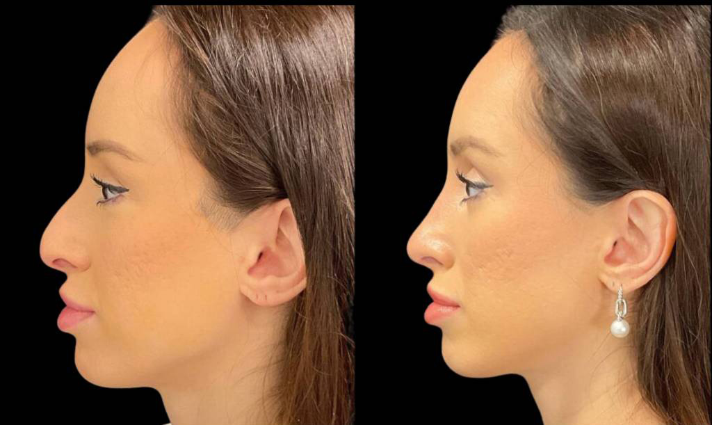 32-year-old-female-rhinoplasty-before-and-after-side-view-1.jpg