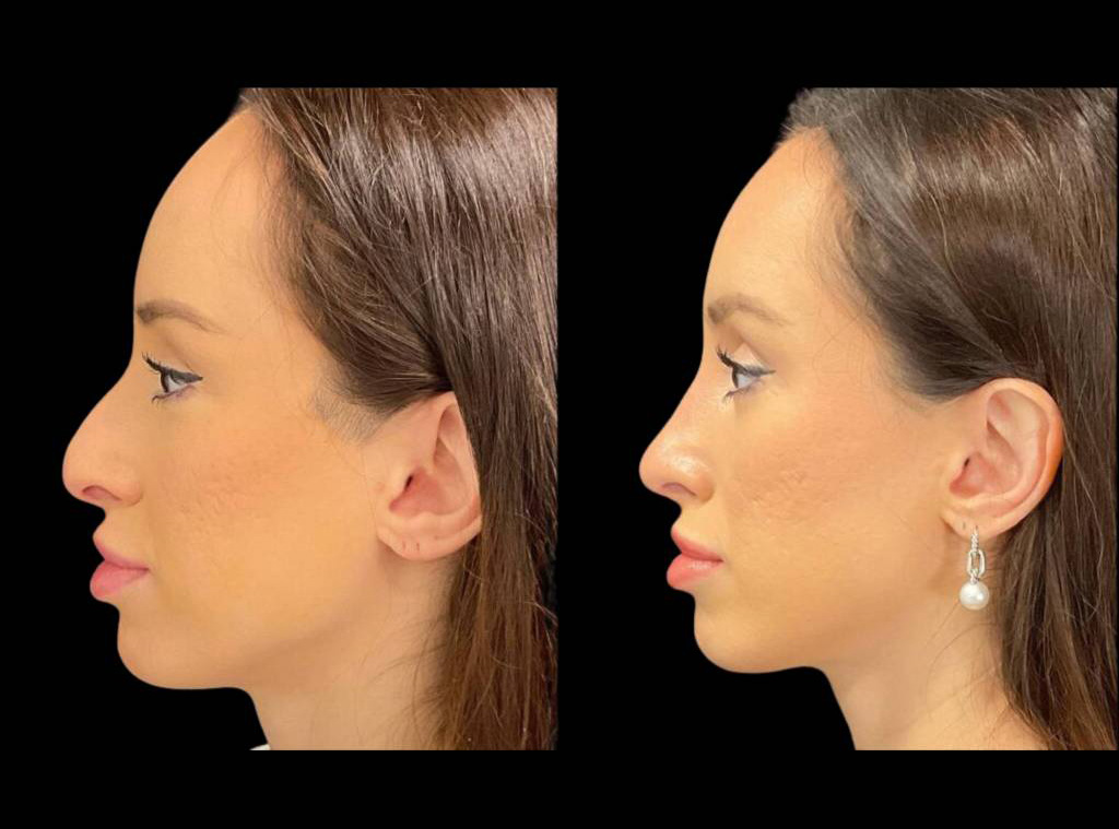 32-year-old-female-rhinoplasty-before-and-after-side-view-1.jpg