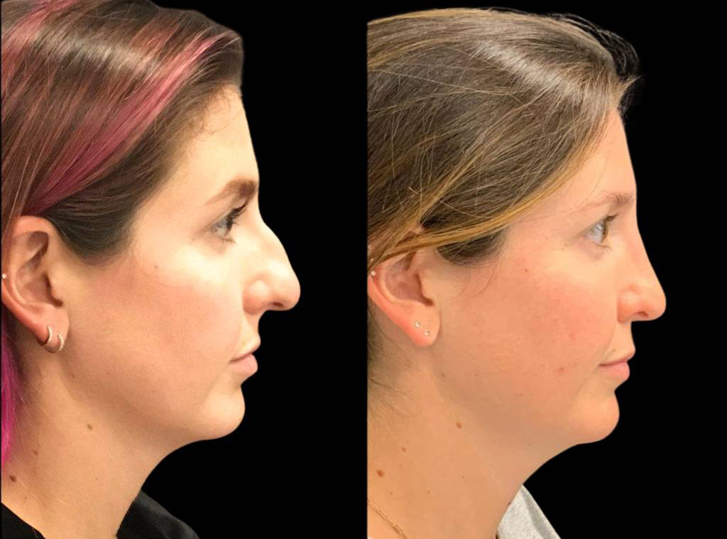 32-year-old-female-rhinoplasty-before-and-after-side-view.jpg