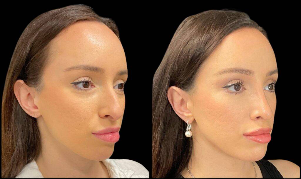 32-year-old-female-rhinoplasty-before-and-after-three-quarters-view-2.jpg