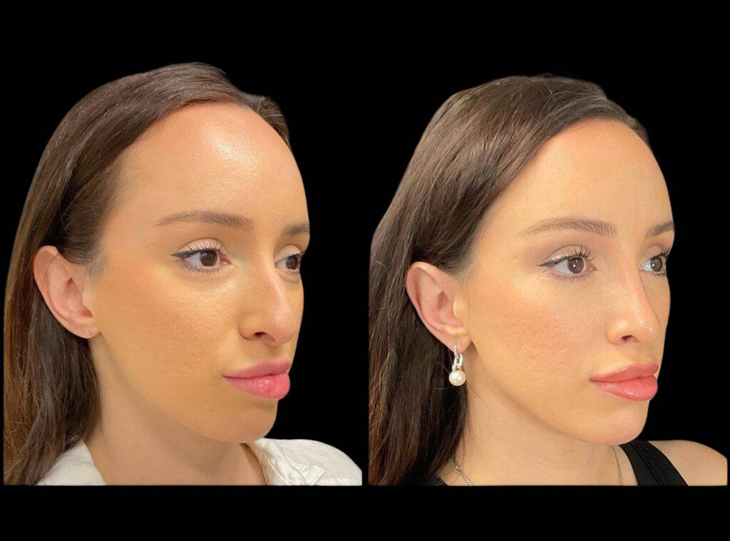 32-year-old-female-rhinoplasty-before-and-after-three-quarters-view-2.jpg