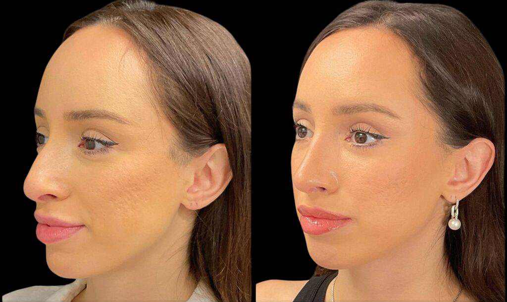 32-year-old-female-rhinoplasty-before-and-after-three-quarters-view-3.jpg