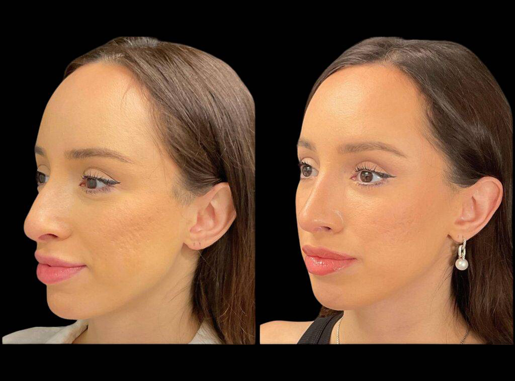 32-year-old-female-rhinoplasty-before-and-after-three-quarters-view-3.jpg