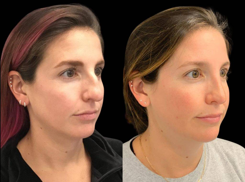 32-year-old-female-rhinoplasty-before-and-after-three-quarters-view.jpg