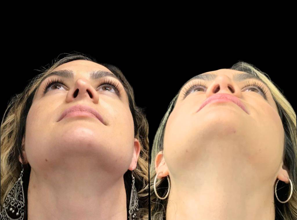 32-year-old-female-rhinoplasty-before-and-after-worms-eye-view.jpg