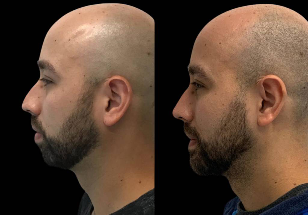 32-year-old-male-chin-implant-before-and-after-side-view.jpg