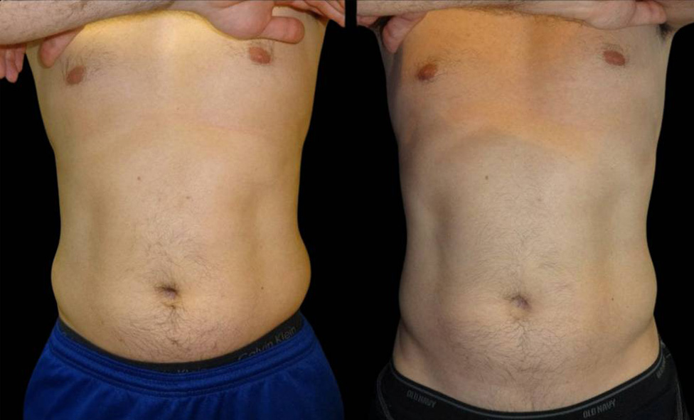 32-year-old-male-coolsculpting-before-and-after-front-view-10106.jpg