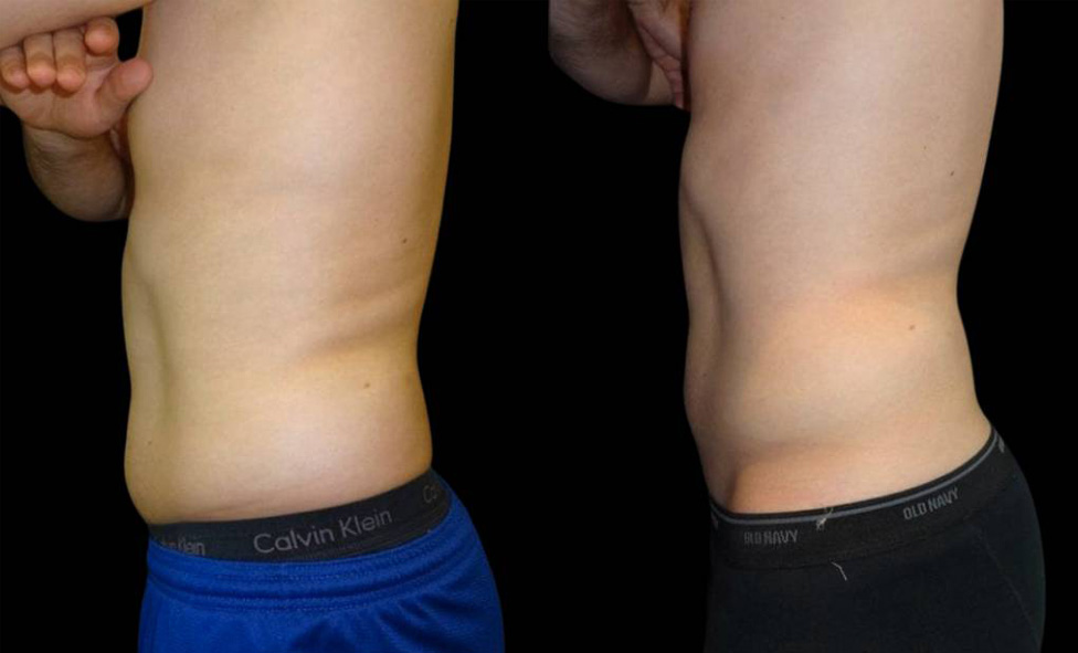 32-year-old-male-coolsculpting-before-and-after-side-view.jpg