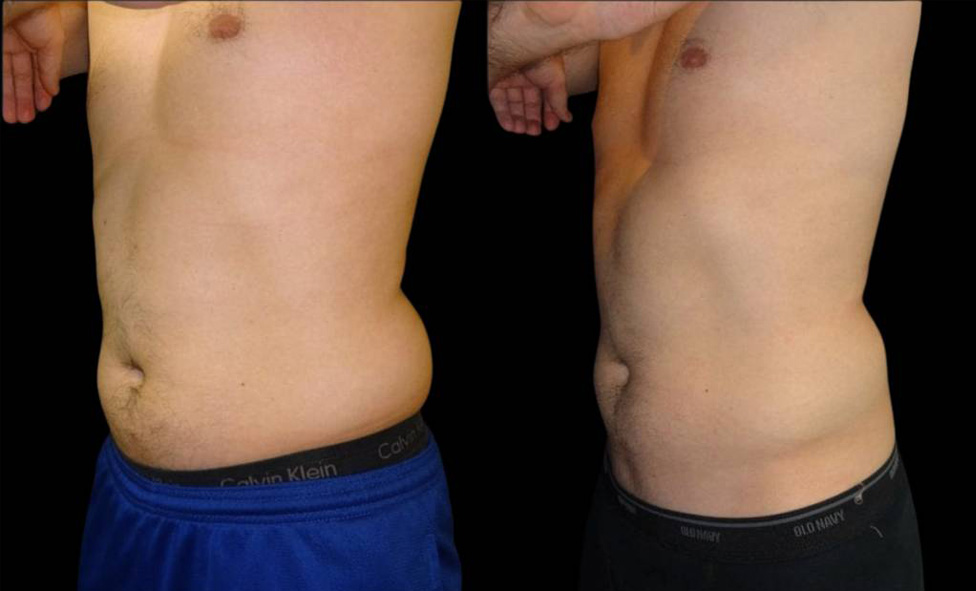 32-year-old-male-coolsculpting-before-and-after-three-quarter-view.jpg