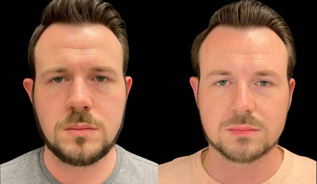 32-year-old-male-ear-pinning-before-and-after-front-view-35782.jpg