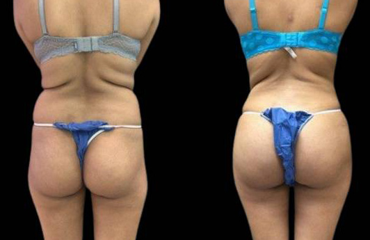 This is a 33-year-old female that has had a brazilian butt lift showing the before and after's side-by-side