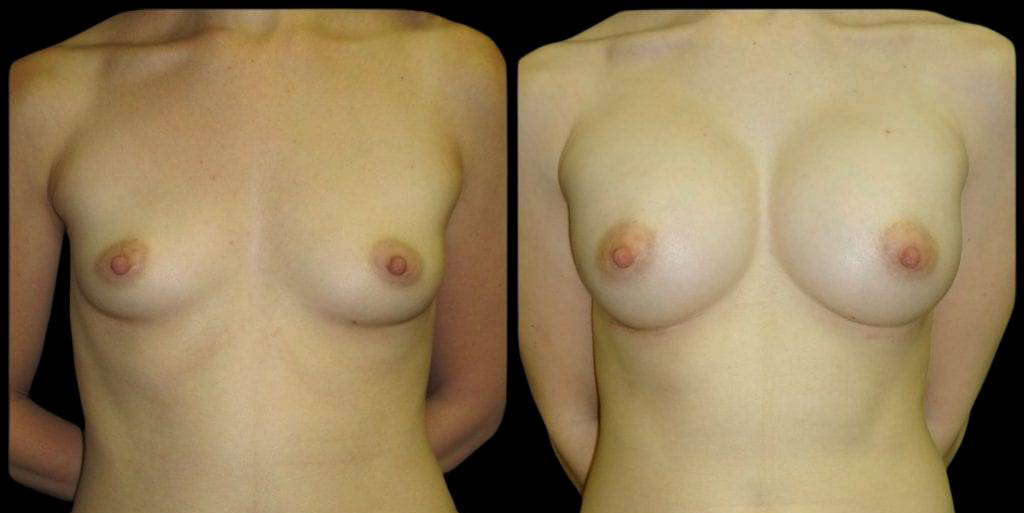 This is a 33-year-old female that has had a breast augmentation and implant showing the before and after's side-by-side