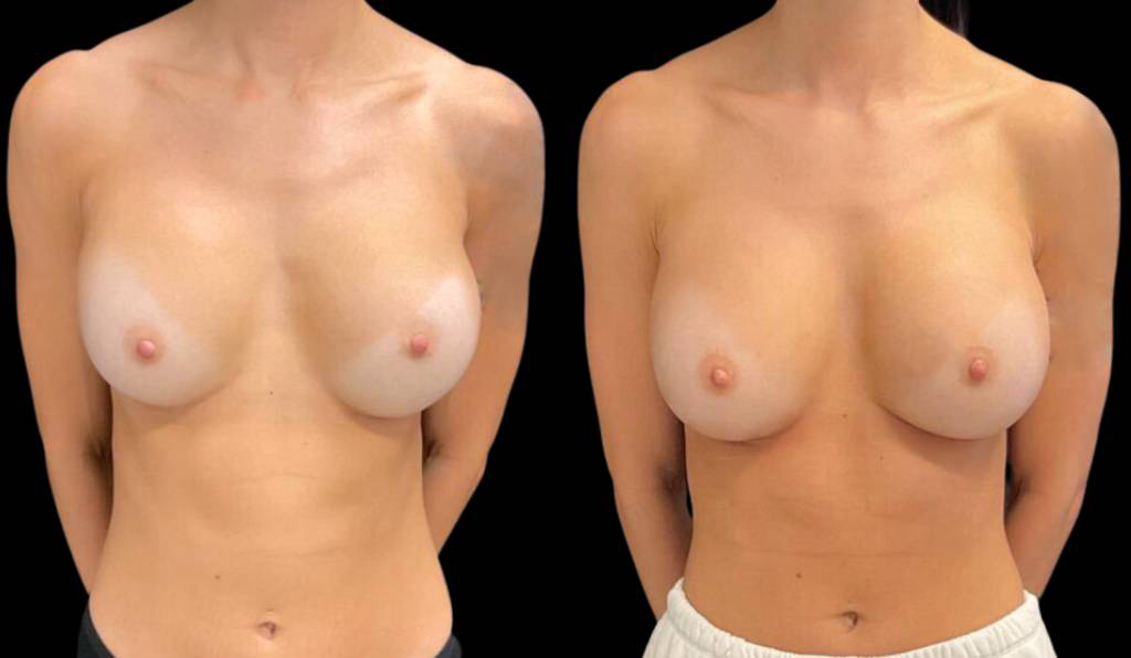 33-year-old-female-breast-implant-exchange-before-and-after-front-view-29888.jpg