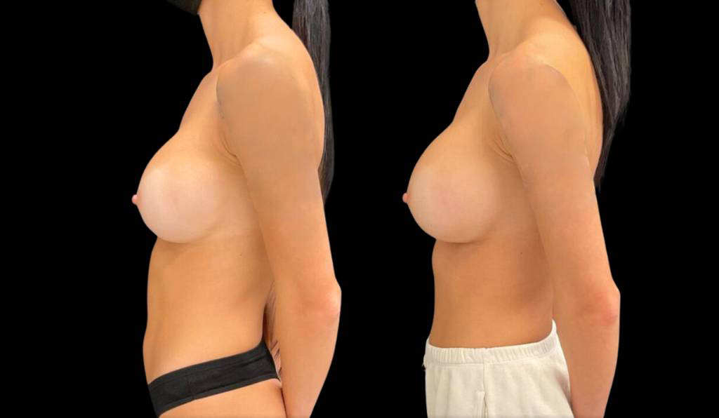 33-year-old-female-breast-implant-exchange-before-and-after-side-view.jpg