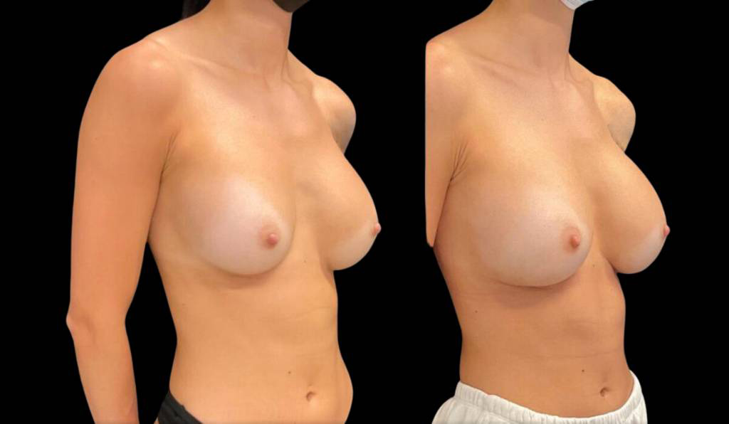 33-year-old-female-breast-implant-exchange-before-and-after-three-quarter-view-2.jpg