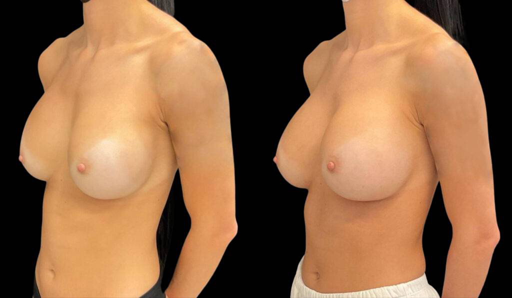 33-year-old-female-breast-implant-exchange-before-and-after-three-quarter-view.jpg