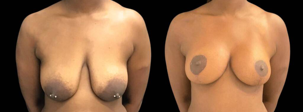 33-year-old-female-breast-lift-before-and-after-front-view-33932.jpg