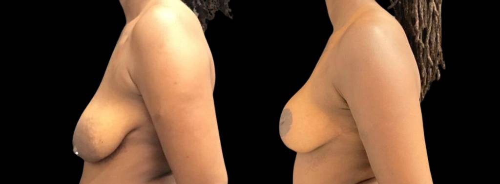 This is a 33-year-old female that has had a breast lift showing the before and after's side-by-side