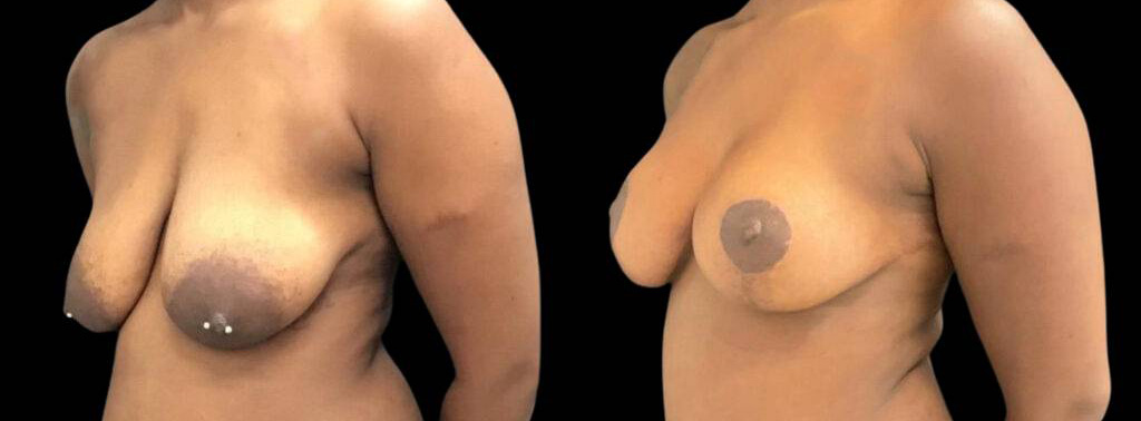 This is a 33-year-old female that has had a breast lift showing the before and after's side-by-side