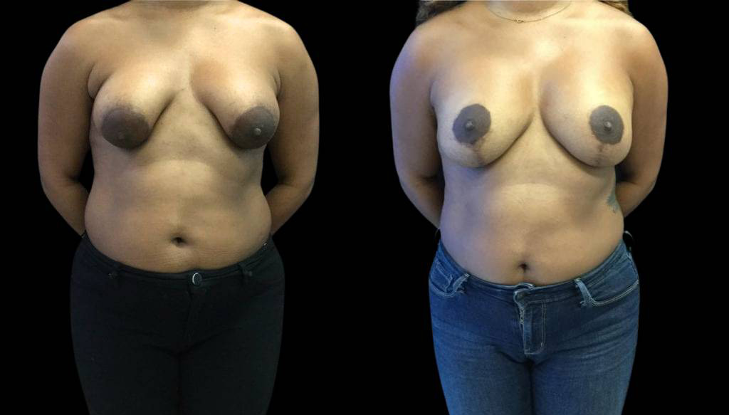 33-year-old-female-breast-lift-with-augmentation-before-and-after-front-view-1.jpg