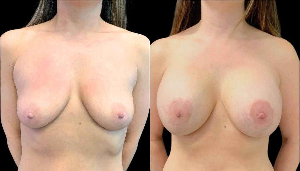 33-year-old-female-breast-lift-with-augmentation-before-and-after-front-view-30830.jpg