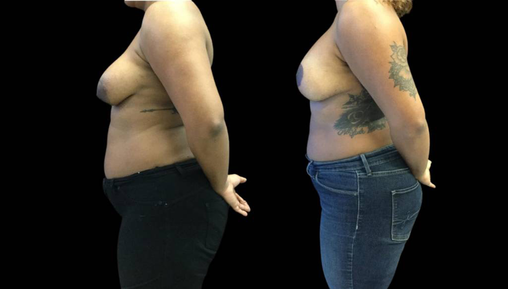 33-year-old-female-breast-lift-with-augmentation-before-and-after-side-view-1.jpg