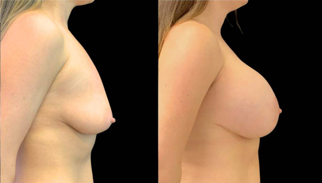 33-year-old-female-breast-lift-with-augmentation-before-and-after-side-view.jpg