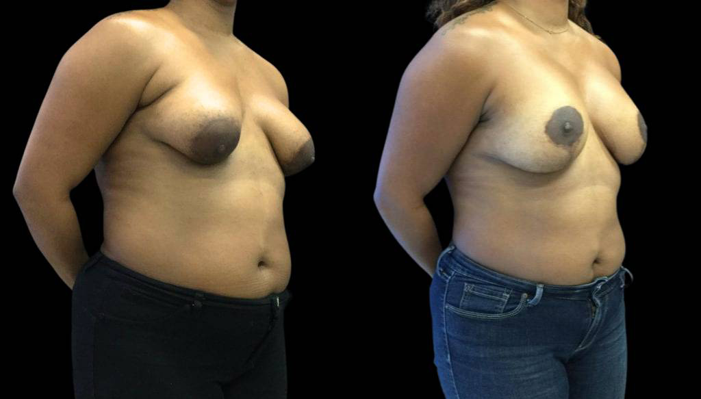33-year-old-female-breast-lift-with-augmentation-before-and-after-three-quarter-view-1.jpg