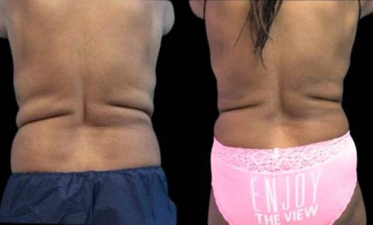 33-year-old-female-coolsculpting-before-and-after-back-view.jpg