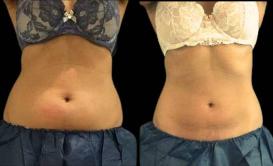 33-year-old-female-coolsculpting-before-and-after-front-view-9363.jpg