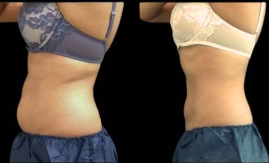 33-year-old-female-coolsculpting-before-and-after-side-view.jpg