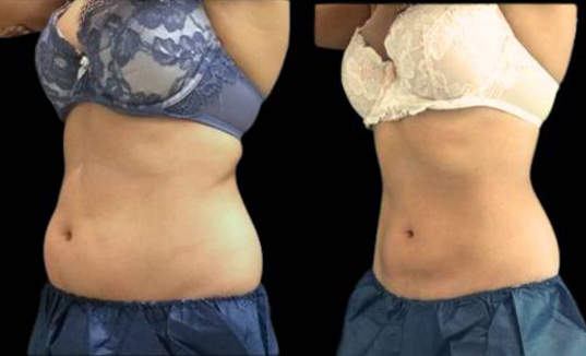 33-year-old-female-coolsculpting-before-and-after-three-quarters-view.jpg