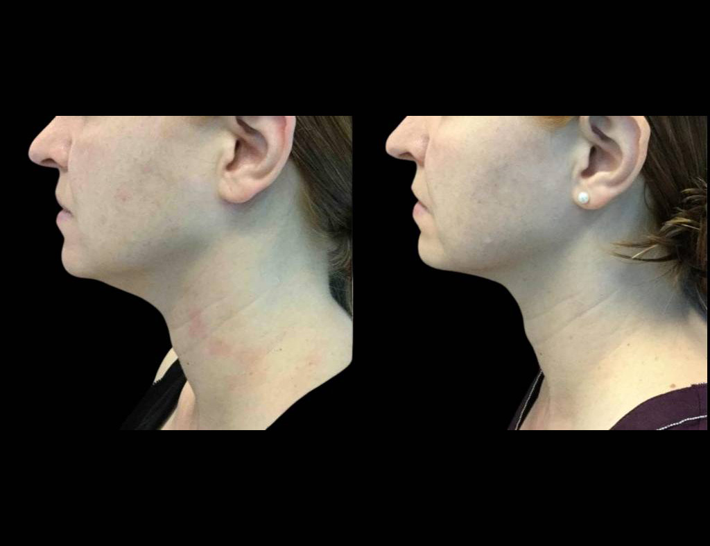 33-year-old-female-kybella-before-and-after-1.jpg