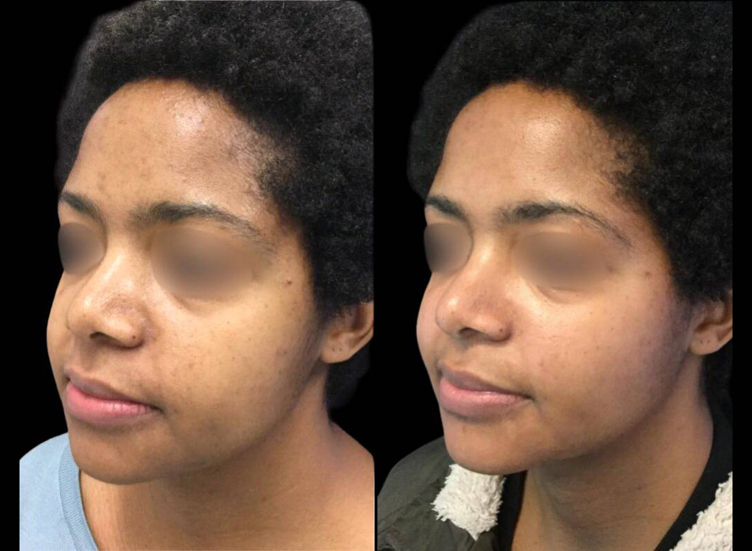 33-year-old-female-melanage-peel-before-and-after-1.jpg