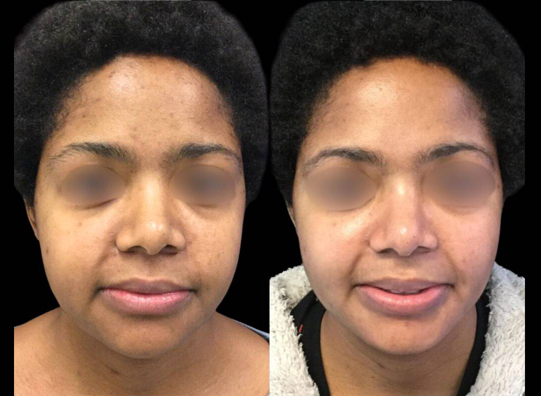 33-year-old-female-melanage-peel-before-and-after.jpg