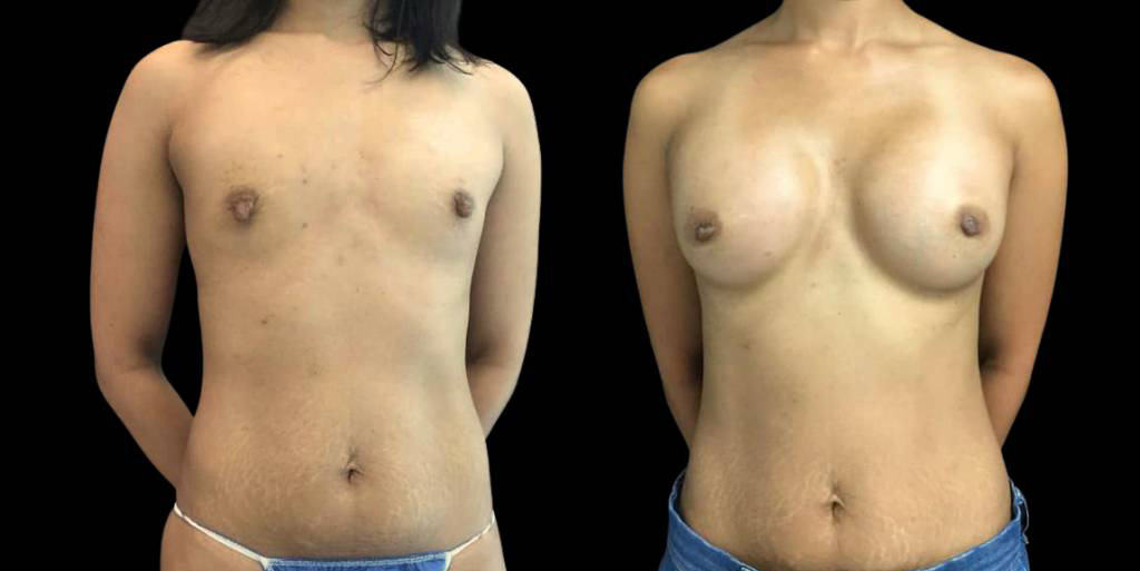 This is a 33-year-old female that has had a breast augmentation and implant showing the before and after's side-by-side