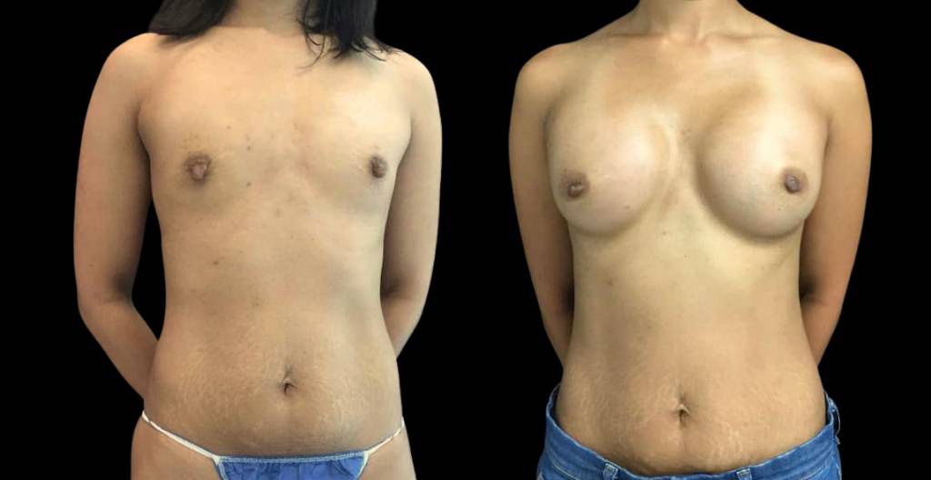 33-year-old-female-nipple-reduction-before-and-after-front-view.jpg