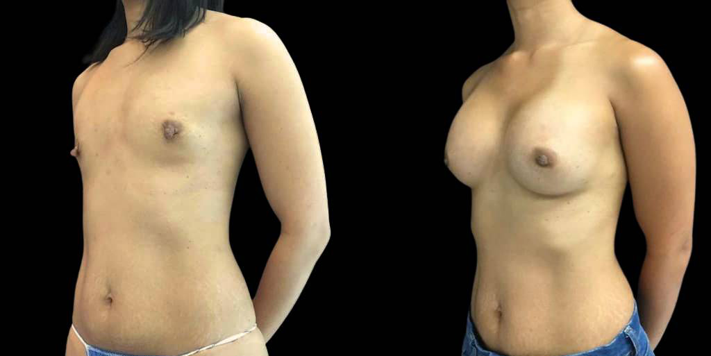 This is a 33-year-old female that has had a breast augmentation and implant showing the before and after's side-by-side